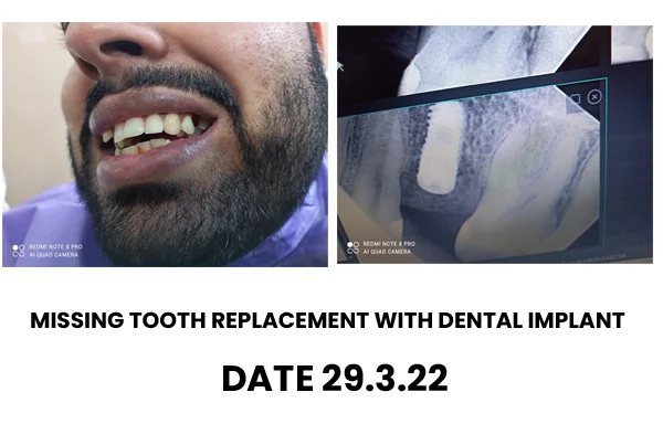 Missing Tooth Treatment