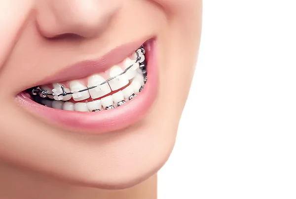Ceramic Braces