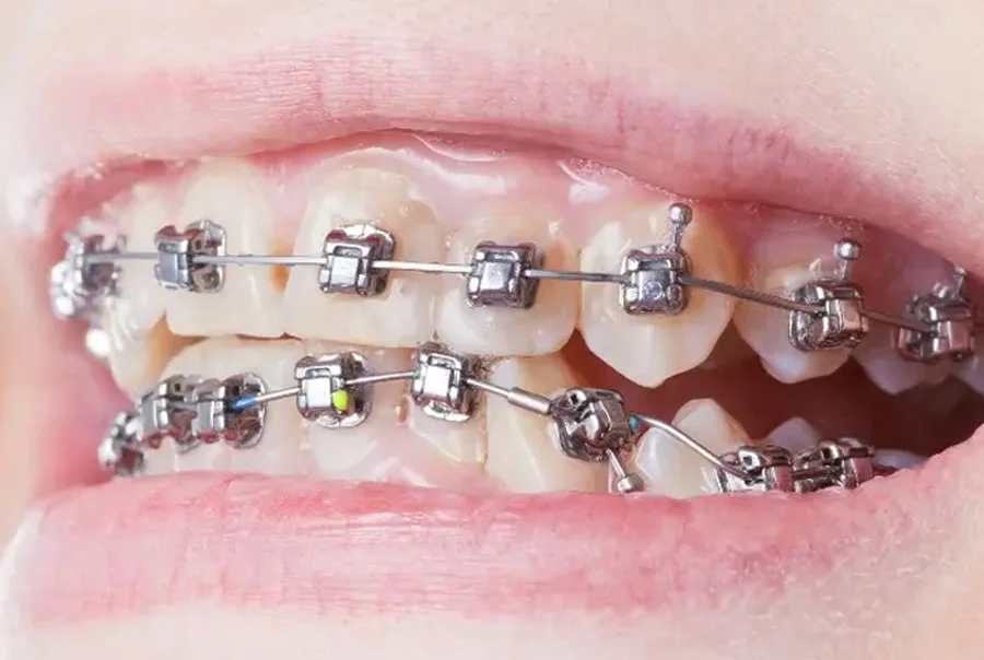 Self Ligating Braces