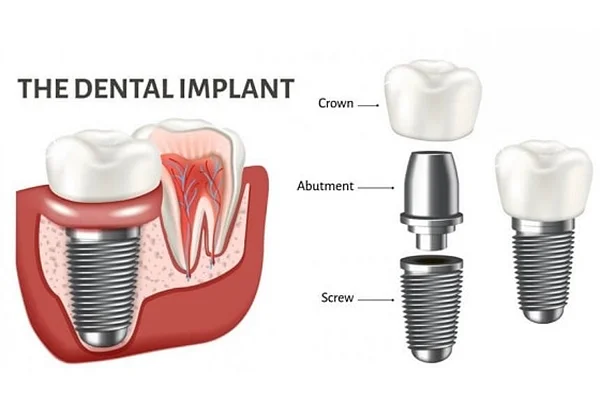 Dental Implants