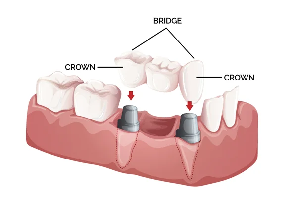 Aesthetic Crowns & Bridges