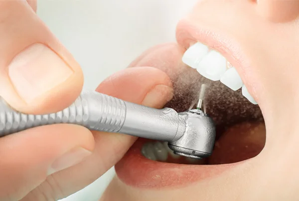 Aesthetic Tooth Fillings