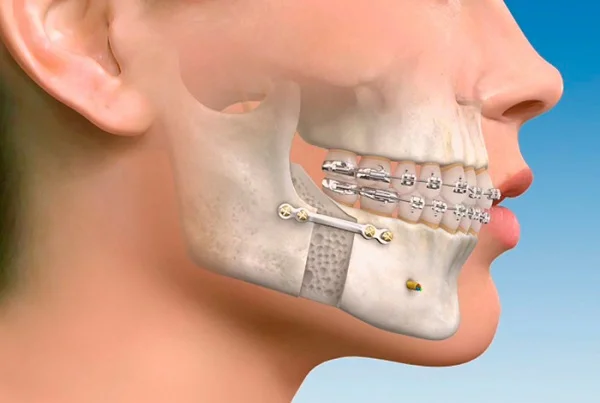 Jaw Fracture Surgery